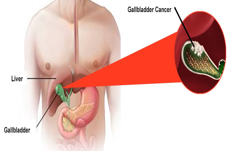 Gallbladder Cancer treatment in Faridabad 