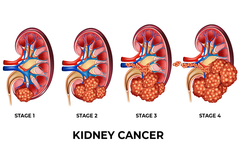 Kidney Cancer treatment in Faridabad