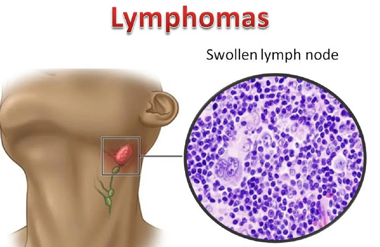 Lymphoma Treatment in Faridabad