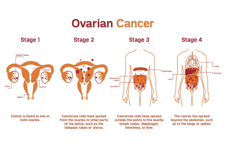 Ovarian Cancer specialist in Faridabad