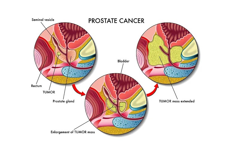 Prostate Cancer treatment in Faridabad