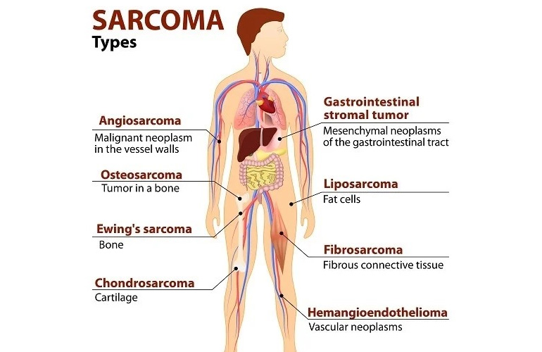 Sarcoma Cancer treatment in Faridabad