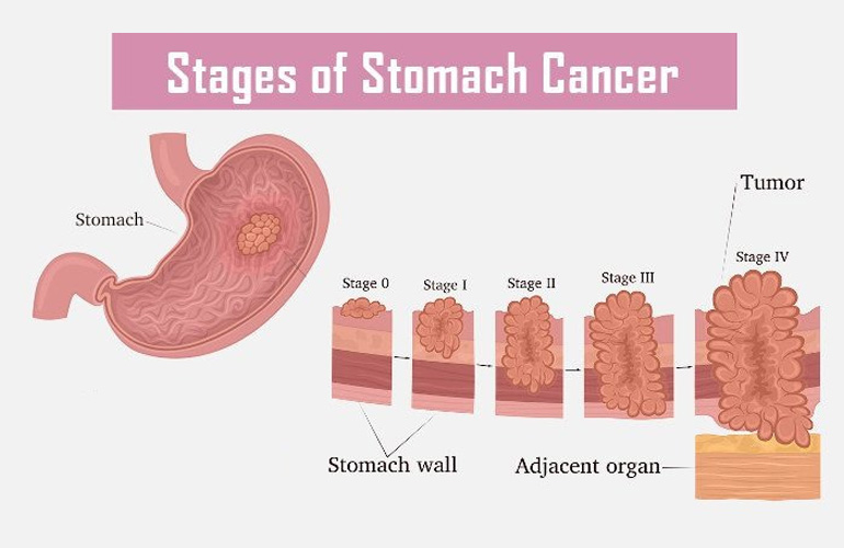 Stomach Cancer treatment in Faridabad